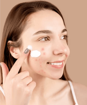 Aichun Beauty - Acne Treatment Gel