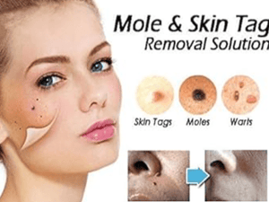 Aichun Beauty - Tag & Wart Removal Cream